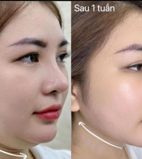 Tan Mỡ Nọng 